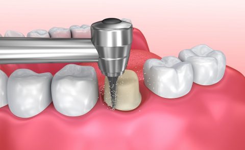 dental crown - cosmetic procedure