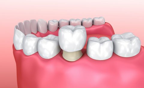 tooth crown - cosmetic dentistry