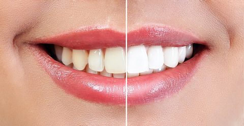 teeth whitening - cosmetic dentist