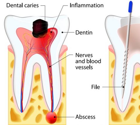 root canal treatment