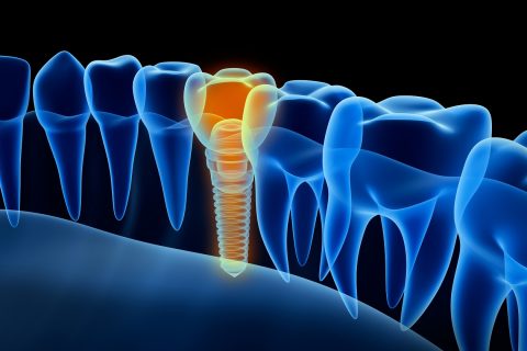 visual of tooth implant from Texas Dental