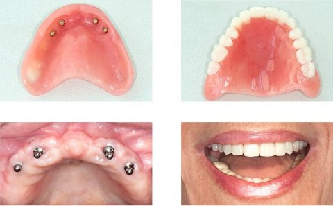 example of full mouth dental implants