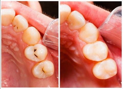 tooth colored dental filling